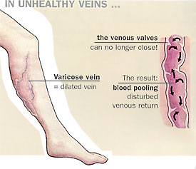 Unhealthy veins