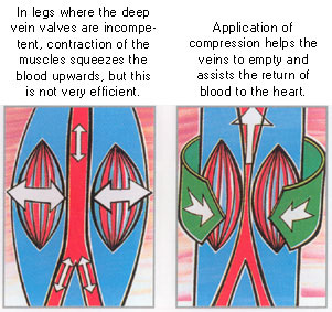 Value compression in legs